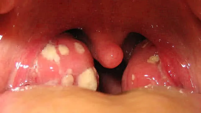 استئصال اللوزتين