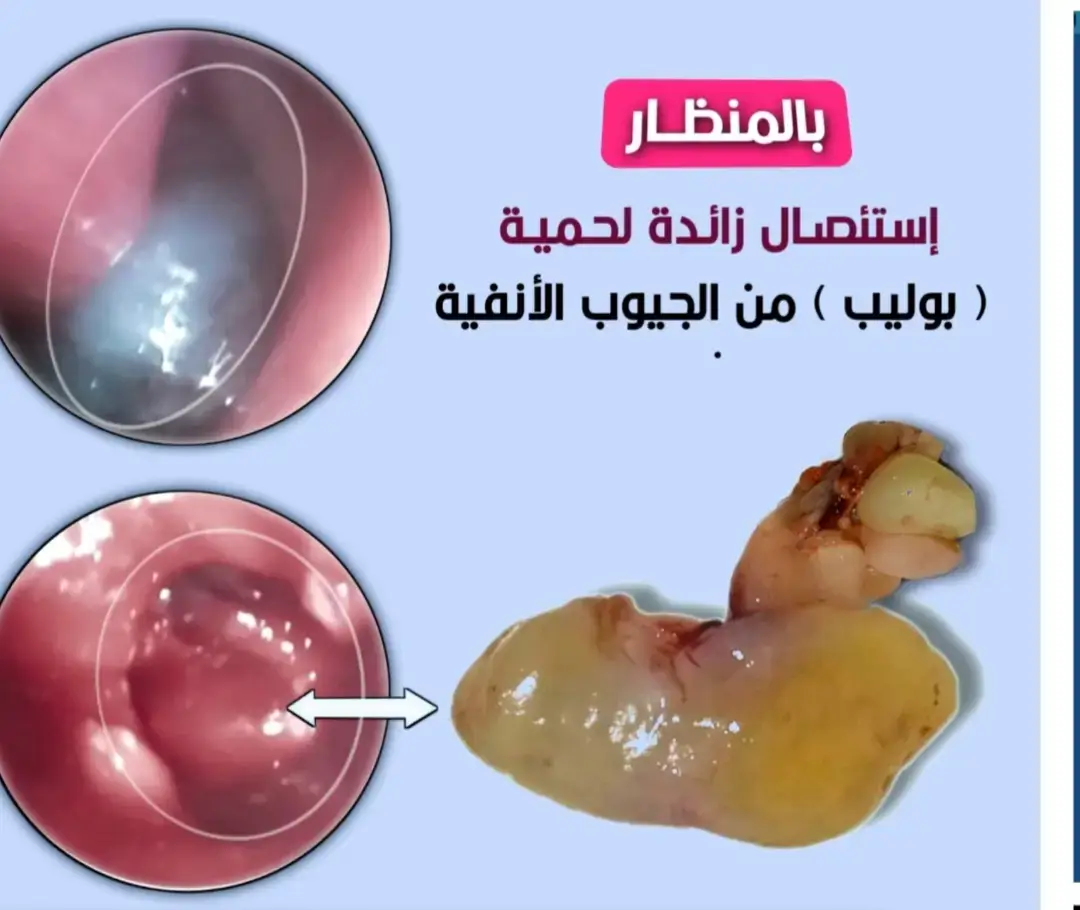 نتيجة عملية جيوب أنفية5